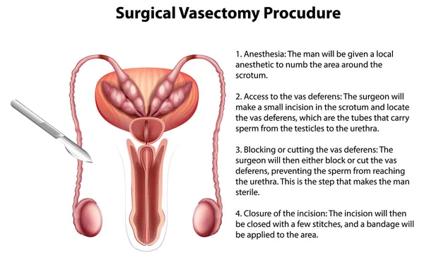 Procudure Infographic Dengan Penjelasan Ilustrasi Dari Pembedahan Vasectomy - Stok Vektor
