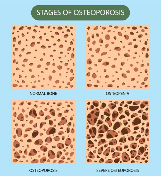 Векторная иллюстрация плотности костей и остеопороза