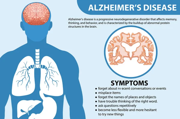 Інформаційний Плакат Ілюстрації Хвороби Альцгеймера — стоковий вектор