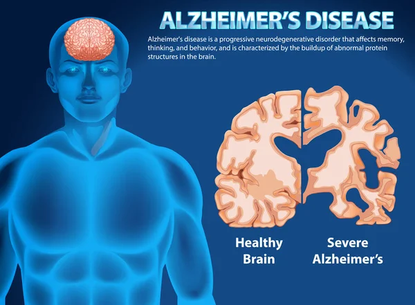 stock vector Informative poster of Alzheimers disease illustration