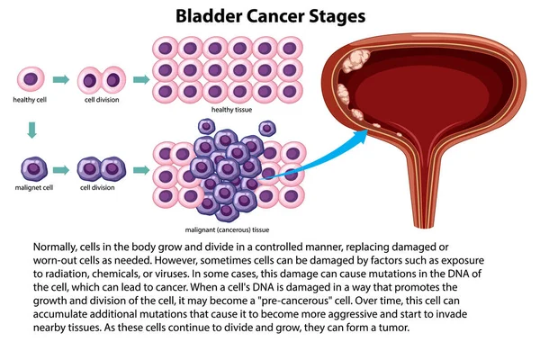 Illustrazione Delle Fasi Informative Del Cancro Alla Vescica — Vettoriale Stock