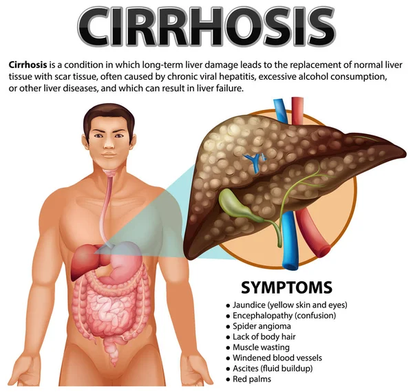 Informační Plakát Alkoholického Onemocnění Jater Ilustrace Cirhózy — Stockový vektor