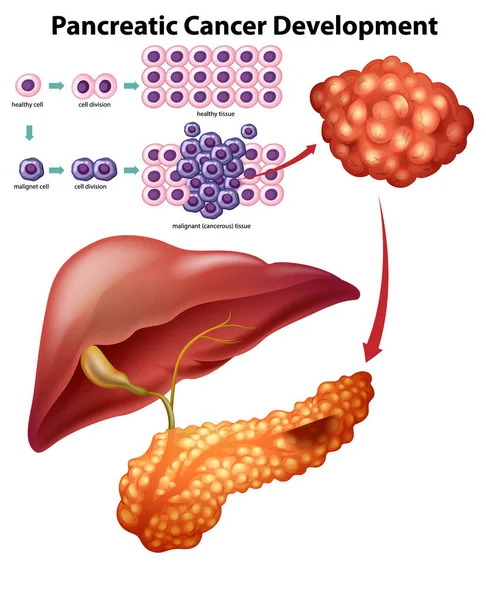 Dezvoltarea Cancerului Pancreatic Ilustrație Infografică — Vector de stoc