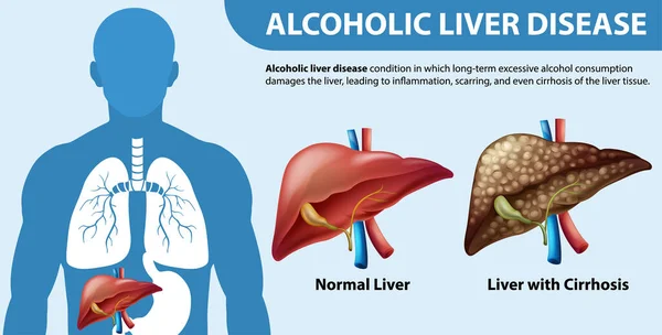Інформаційний Плакат Про Алкогольні Захворювання Печінки Ілюстрація Цирозу — стоковий вектор