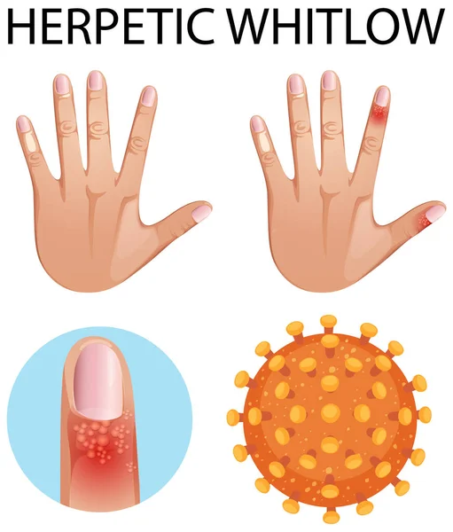 Mänskligt Finger Med Herpetisk Whitlow Hudsjukdom Illustration — Stock vektor
