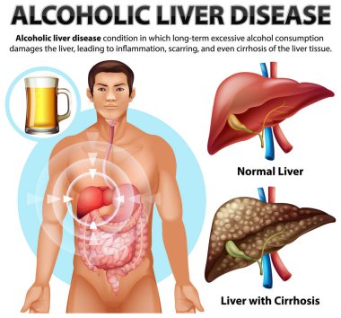 Alkolik karaciğer hastalığının bilgilendirici posteri. Siroz çizimi.