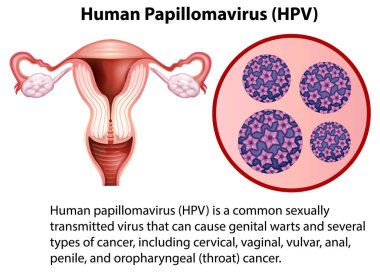 Human Papillomavirus with explanation illustration