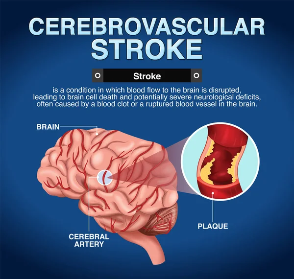 Informační Plakát Cerebrovaskulární Mozková Mrtvice05 Ilustrace — Stockový vektor
