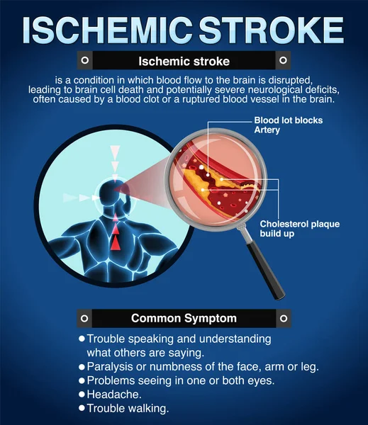 Informativ Affisch Ischemic Stroke Illustration — Stock vektor