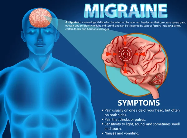 Migren Illüstrasyonunun Bilgilendirici Posteri — Stok Vektör