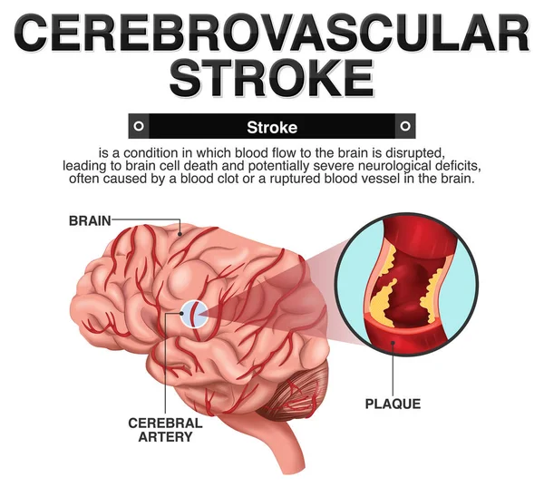 Informative Poster Cerebrovascular Stroke Illustration — Stock Vector