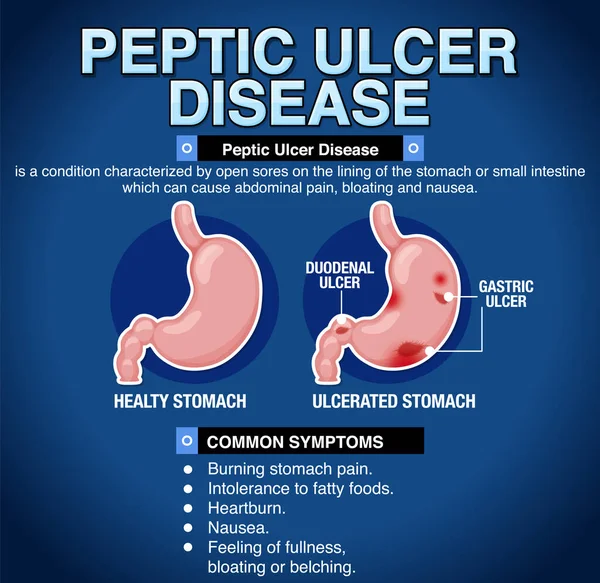 Illustrazione Infografica Spiegata Della Malattia Dell Ulcera Peptica — Vettoriale Stock
