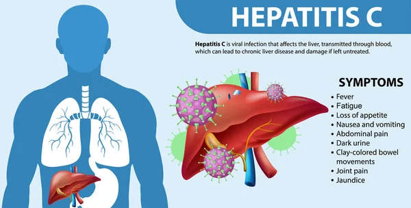 Informative Symptoms Hepatitis Illustration — Stock Vector