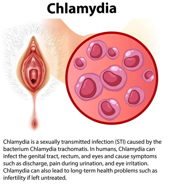 Chlamydia Trachomatis Explanation Illustration - Stok Vektor