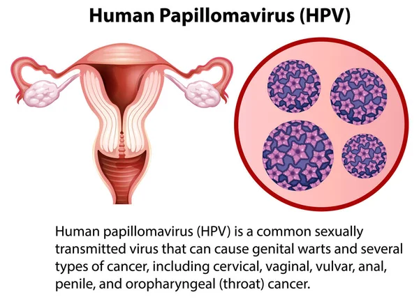 Human Papillomavirus Explanation Illustration - Stok Vektor