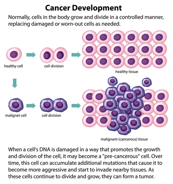 Vektor Pengembangan Kanker Dengan Ilustrasi Informasi - Stok Vektor