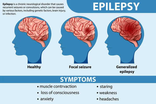 Epilepsi Illüstrasyonunun Bilgilendirici Posteri — Stok Vektör