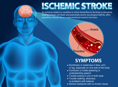 İskemik vuruş illüstrasyonunun bilgilendirici posteri