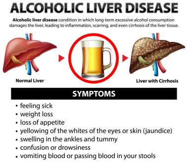 Alkolik karaciğer hastalığının bilgilendirici posteri. Siroz çizimi.