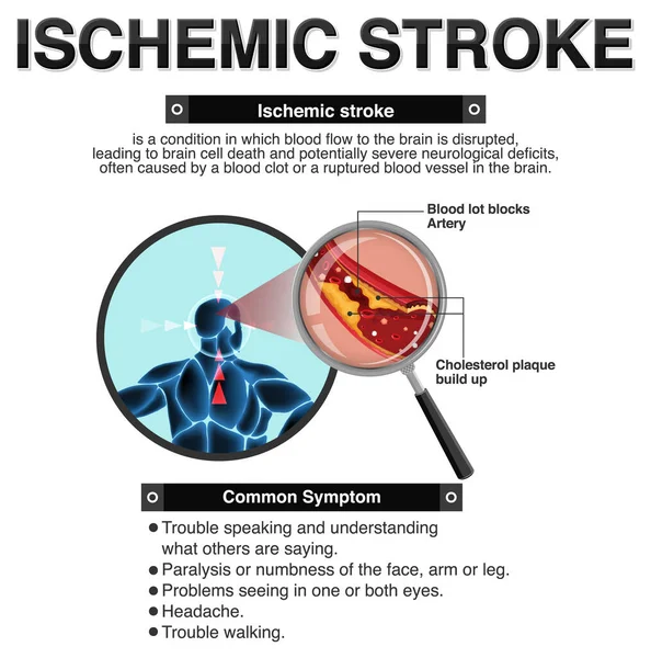İskemik vuruş illüstrasyonunun bilgilendirici posteri