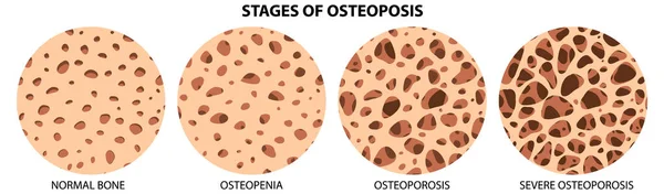 Estágios Osteoposis Ilustração Vetorial — Vetor de Stock