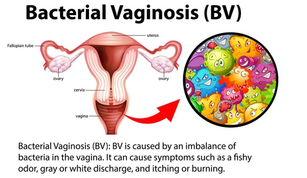 Vaginosis Bakteri Infografis Dengan Ilustrasi Penjelasan - Stok Vektor
