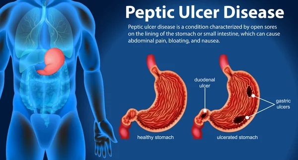 Ulcera Peptica Illustrazione Infografica — Vettoriale Stock