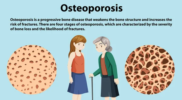 Botdichtheid Osteoporose Vectorillustratie — Stockvector