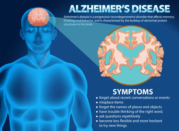 Poster Informatif Dari Ilustrasi Penyakit Alzheimers - Stok Vektor