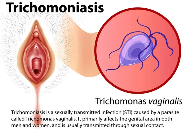 Infografía Tricomoniasis Con Ilustración Explicativa — Vector de stock
