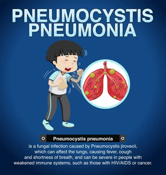 Cartaz Informativo Ilustração Pneumocystis Pneumonia — Vetor de Stock