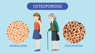 Kemik Yoğunluğu ve Osteoporoz Vektör İllüstrasyonu
