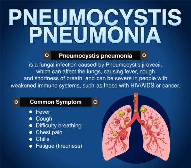 Pneumocystis pnömoni illüstrasyonunun bilgilendirici posteri