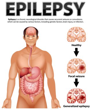 Epilepsi illüstrasyonunun bilgilendirici posteri