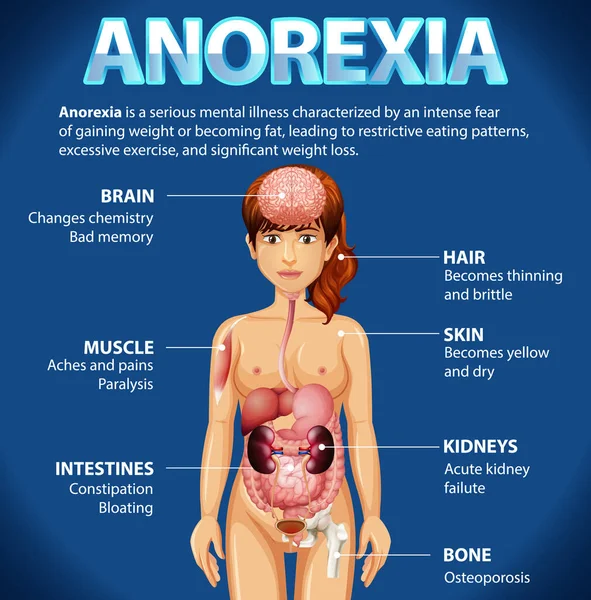 Anorexia Yeme Bozukluğu Illüstrasyonunun Bilgilendirici Posteri — Stok Vektör