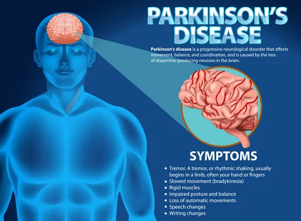 Информационный Плакат Иллюстрации Болезни Паркинсона — стоковый вектор