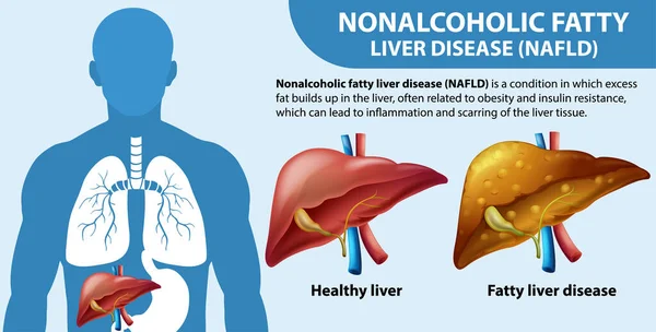 Ilustracja Bezalkoholowej Choroby Wątroby Tłuszczowej Nafld — Wektor stockowy
