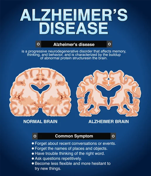 Информационный Плакат Иллюстрации Болезни Альцгеймера — стоковый вектор