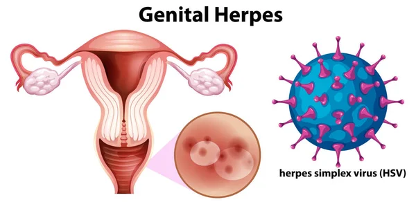 Herpes Genital Dengan Ilustrasi Virus Herpes Simplex Hsv - Stok Vektor