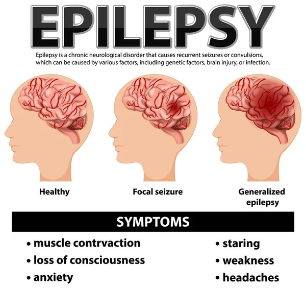 Cartel Informativo Epilepsia Ilustración — Archivo Imágenes Vectoriales