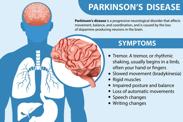 Parkinson Kór Illusztrációjának Tájékoztató Plakátja — Stock Vector