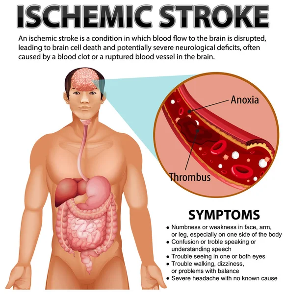 Informační Plakát Ischemic Stroke Illustration — Stockový vektor