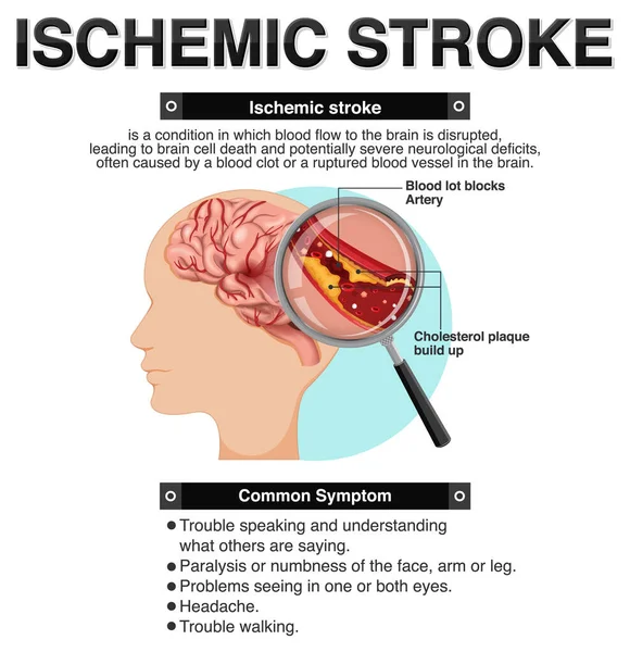 Informativ Affisch Ischemic Stroke Illustration — Stock vektor
