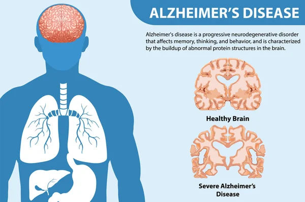 Alzheimer Hastalığı Illüstrasyonunun Bilgilendirici Posteri — Stok Vektör