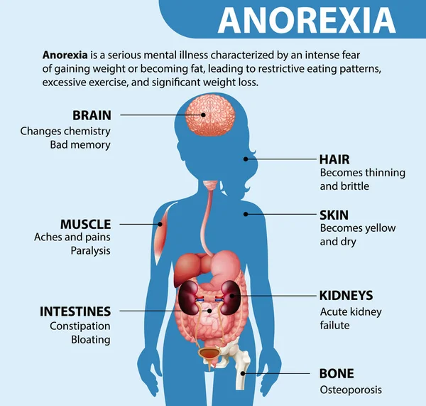 Informativ Affisch Anorexia Ätstörningar Illustration — Stock vektor