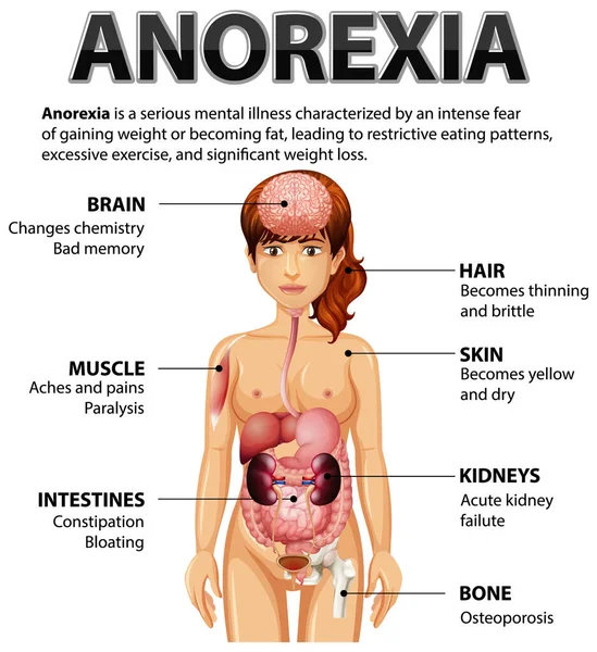Anorexia Yeme Bozukluğu Illüstrasyonunun Bilgilendirici Posteri — Stok Vektör