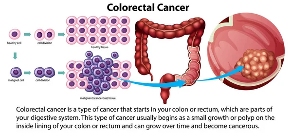 Колоректальный Рак Иллюстрацией Объяснения — стоковый вектор