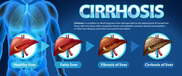 stock vector Informative poster of alcoholic liver disease Cirrhosis illustration