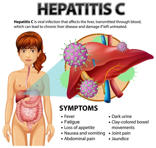 Symtom Hepatit Illustration — Stock vektor