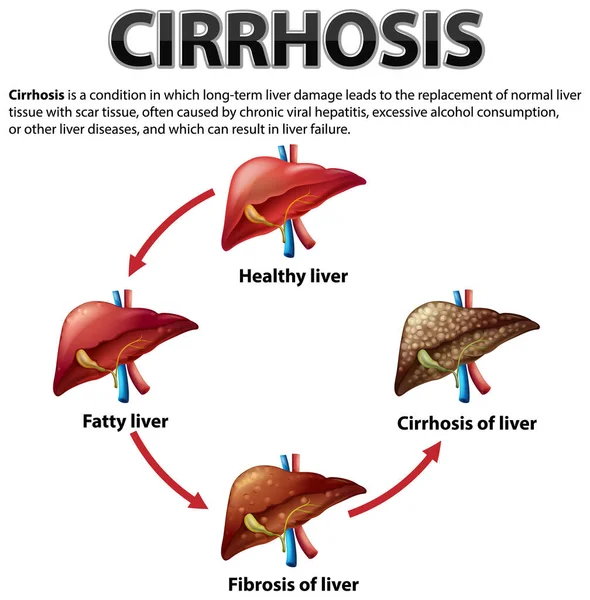 Informative Poster Alcoholic Liver Disease Cirrhosis Illustration — Stock Vector
